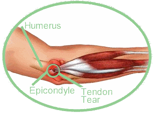 Tennis-elbow-Treatment-Orthopedic-Doctor-New-York