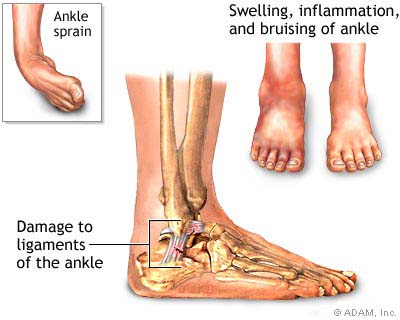 ankle_sprain