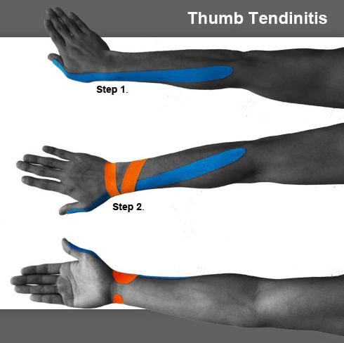 10_thumb_tendinitis
