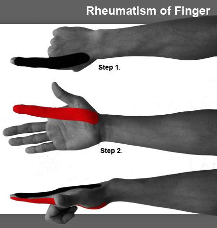 11_fingerrheumatism-1