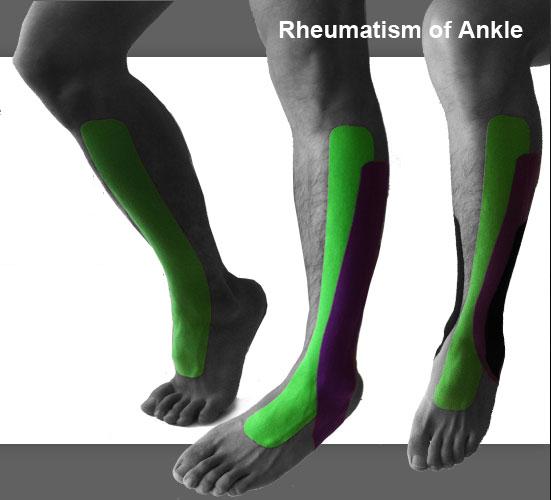 ankle_rheuma
