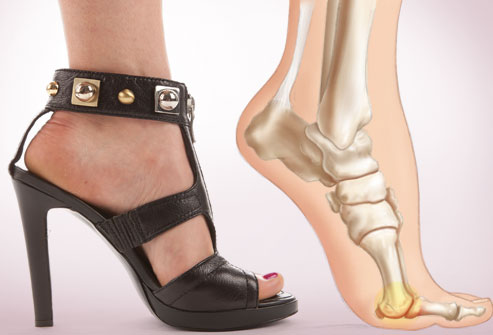 webmd_rf_photo_of_foot_pain_from_heels