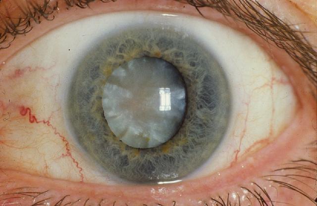 Scientists-Have-Developed-Eye-Drops-That-Can-Melt-Away-Cataracts-compressor