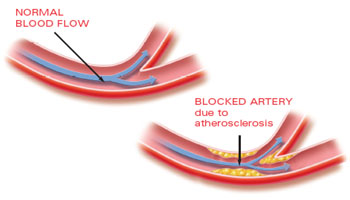 clogged-artery