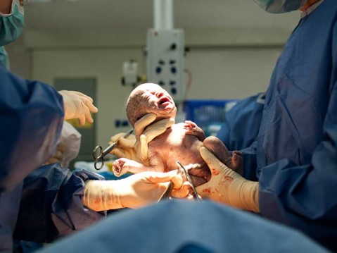 Elective C-Section Could Risk Kids' Long-Term Health