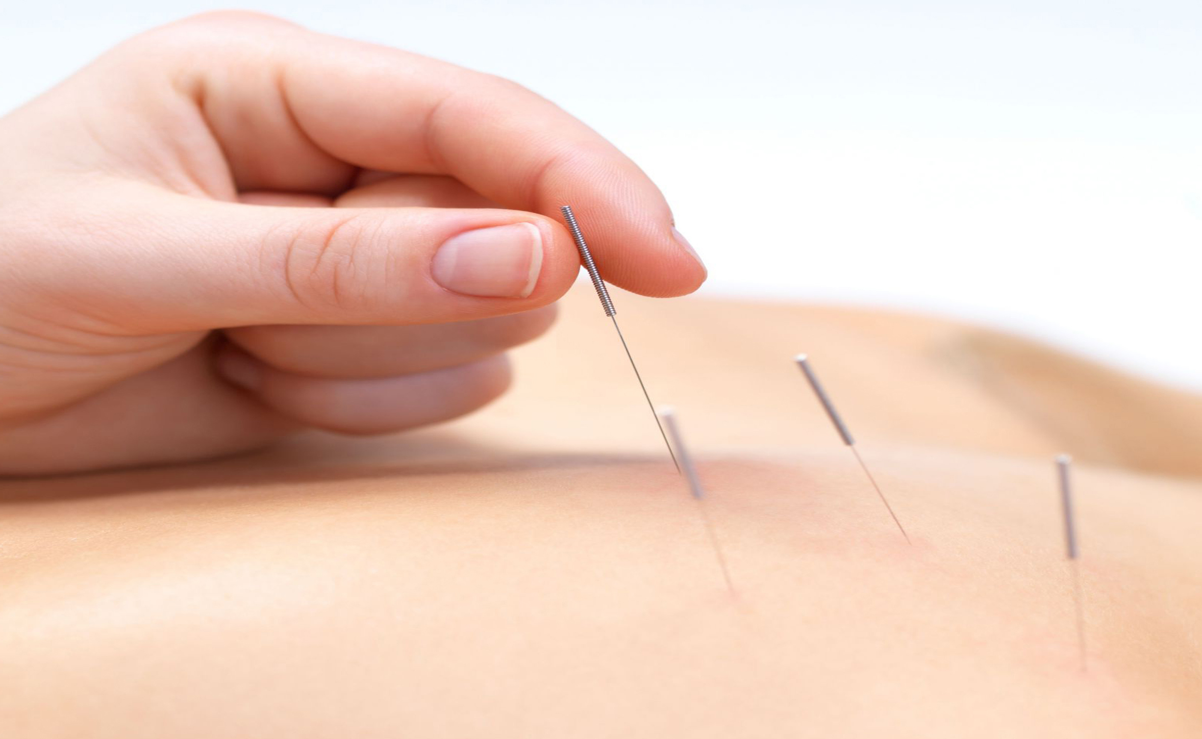 FDA Proposes That Doctors Learn About Acupuncture for Pain 